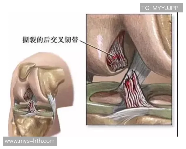 谷泽浴右膝内侧副韧带渐层撕裂：损伤诊断与康复之路全解析